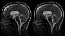 Az MRI segítségével láthatóvá válik az agy koponyán belüli mozgása.