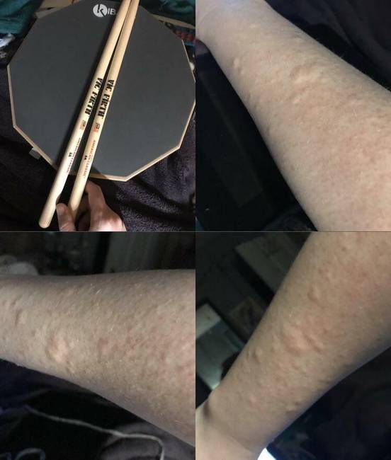 A régóta várt vásárlás tragédiával végződött a latex allergia miatt.