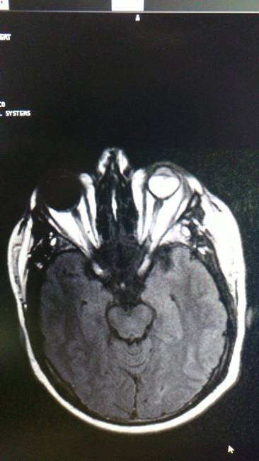 Az MRI felvételeken a vak szem fekete színű.