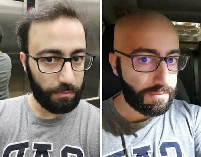 „Beleuntam a kopasz foltokba, és az egyik reggel úgy ébredtem, hogy leborotválom."