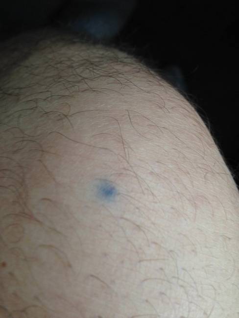 Ez a fickó egy tollal szúrta lábon magát 8. osztályos korában, de ahogy a képen is látszik, a grafithoz hasonlóan a bőr alá tinta sem tűnik el egykönnyen.