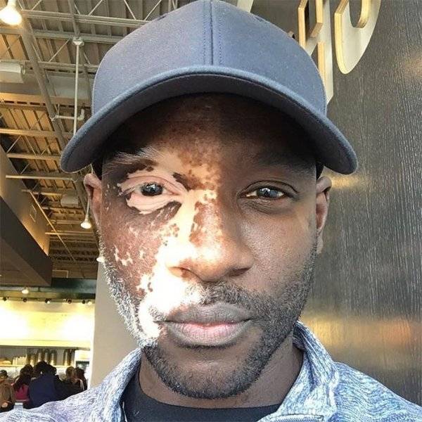 Vitiligo, ami csak az arca egyik oldalát érinti.