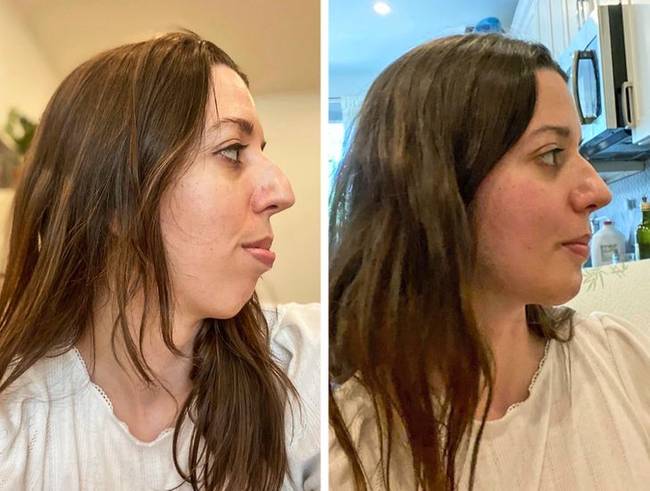 „15 nappal az állkapocs- és állműtét után."