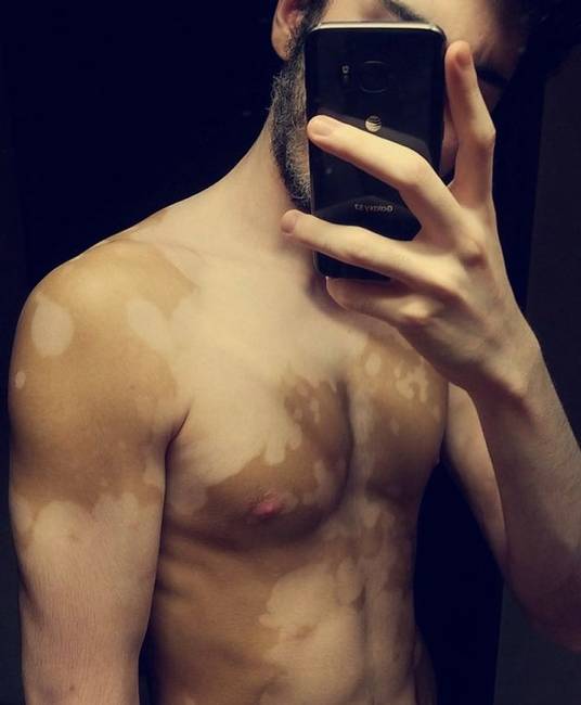 „Vitiligo betegségnek hívják, én művészetnek."