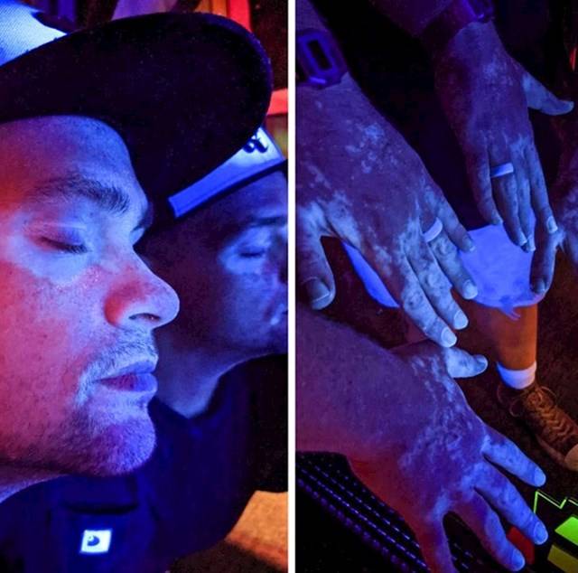 Így néz ki a vitiligo bőrbetegség neonfény alatt.