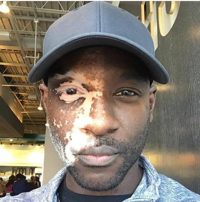 Olyan, mintha az arcának a felét a nap megvilágítaná, pedig ez valójában a vitiligo nevű bőrbetegség egyik tünete.