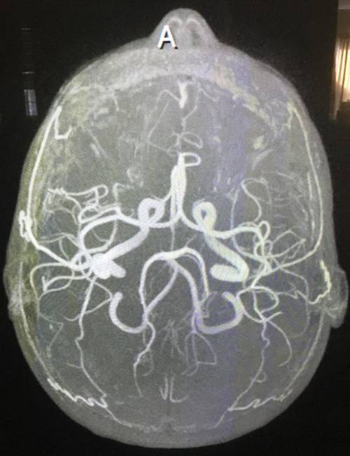 Az MRI segítségével láthatóvá válnak az agyi artériák.