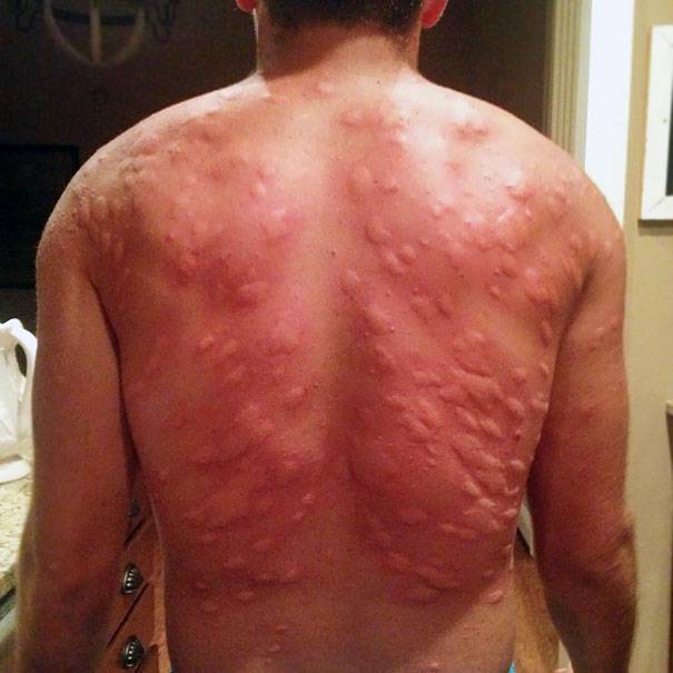 „A haverom tegnap este kempingezés közben elfelejtette befújni magát szúnyogriasztó sprayvel. Persze berúgott és elaludt a füvön...”