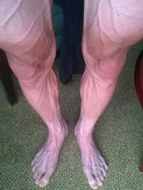 Ez pedig egy Tour de France versenyző lábai, kerékpározás után.