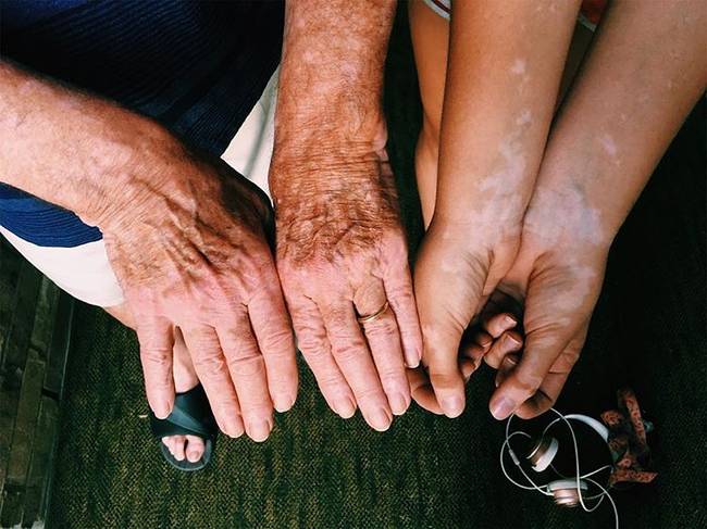 A vitiligo nevű bőrbetegség, nagymamánál és unokájánál.