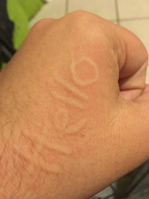 „Dermatográfiám (túlérzékenység) van, vagyis közvetlenül a bőrömre is írhatok."