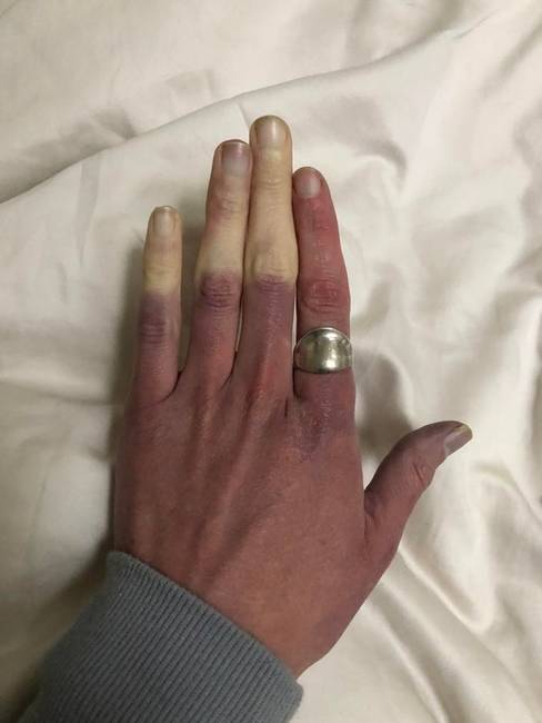 „Amikor hideg van, az ujjaimból eltűnik a vérkeringés."