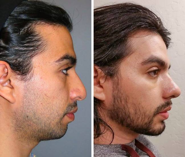 A rhinoplastia és a genioplasztika eredményei.