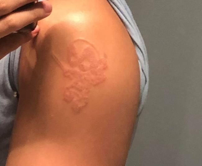 „A bőröm adottsága miatt a henna tetoválásom okozta heg nem múlik el."