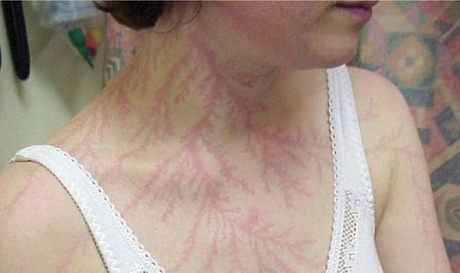 Így néz ki egy villámcsapást átélt emberi test. A jelenséget Lichtenberg-féle ábrának hívjuk.