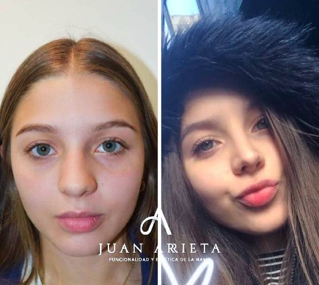 „2 évvel az orrplasztikám után. Le vagyok nyűgözve a változástól."