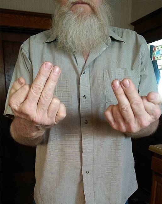 „Apámnak mindkét kezén 6 ujja van. 2 ujját kell használnia, hogy valakinek bemutasson."