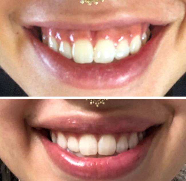 „A botox segített megszabadulni a kellemetlen mosolyomtól."