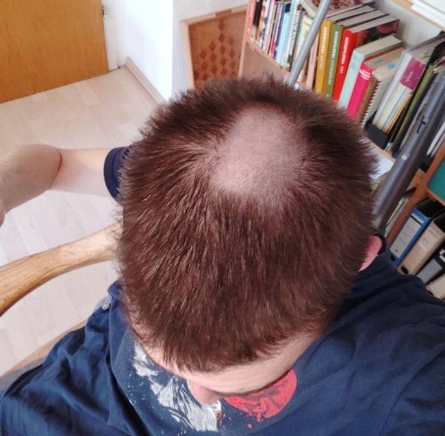 „Apám elfelejtette felrakni a hajvágó gépre a műanyag véget, amikor levágta a hajam."