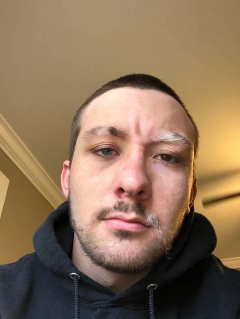 „Ilyen vagyok én: vitiligo és heterokrómia."