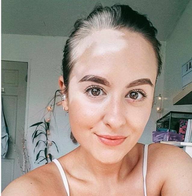 „16 évig próbáltam rejtegetni a vitiligo betegségem, de megbékéltem vele és elfogadtam.”