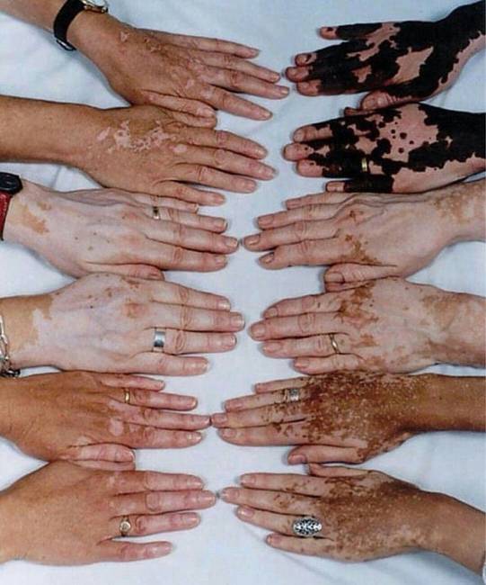 Vitiligo betegség a különböző bőrszínű embereknél.