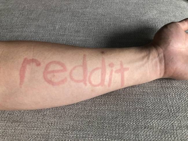 A dermatográfia nevű bőrbetegség miatt ennek a lánynak a bőre olyan érzékeny, hogy szó szerint „írni" lehet rá, ha hozzáérünk.