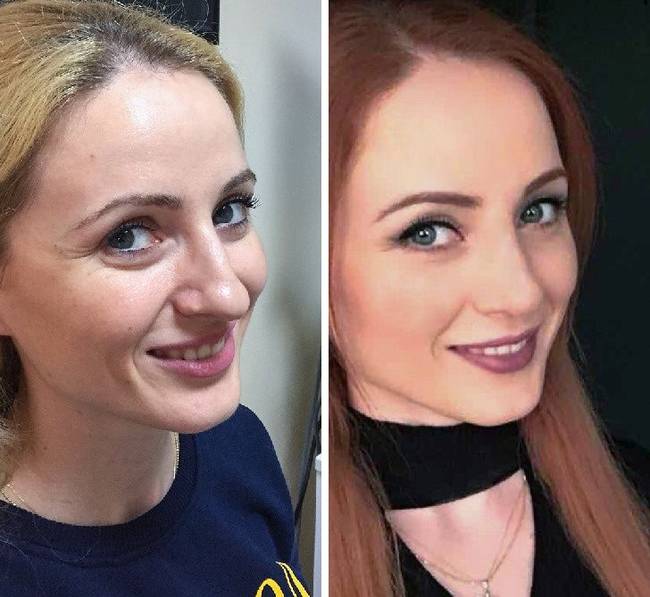 20 nő, aki megcsináltatta az orrát, és most nem hiszed el, hogy ugyanaz a személy van a fotón