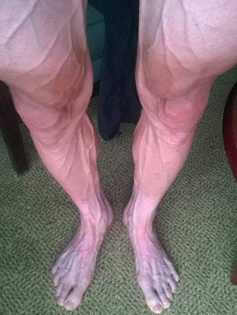 Így néz ki egy kerékpáros lába a Tour de France verseny után.