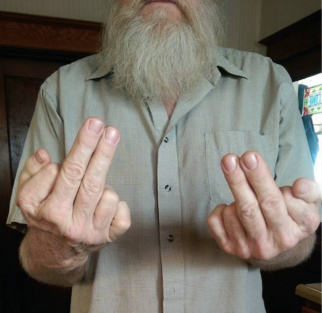 „Apámnak mindkét kezén 6 ujja van."