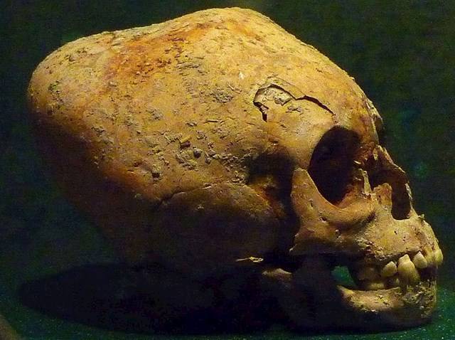 9 bizarr hagyomány, amit az emberek egykoron azért csináltak, hogy szebbnek tűnjenek