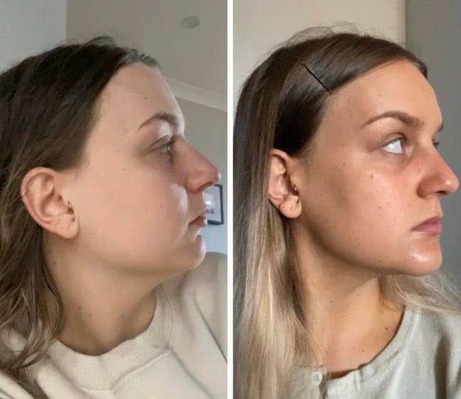 „8 héttel a műtét előtt és után. Alsó állkapocs + genioplasztika előtt és után."