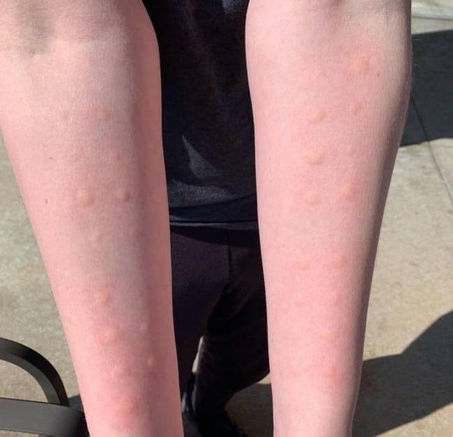 „Allergiatesztet végeztem, és kiderült, hogy szinte mindenre allergiás vagyok."