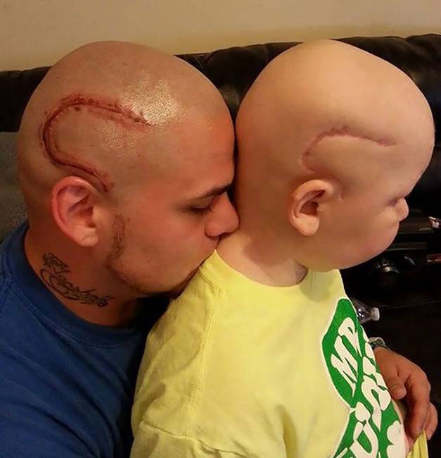 „A kisfiam szégyellte a hegét, amit egy agydaganat miatti műtét során szerzett, ezért magamra tetováltattam én is egy ugyanolyan heget, hogy jobban érezze magát."