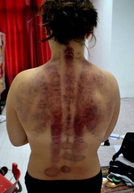 A Kínában népszerű Gua Sha-masszázs garantálja, hogy lila háttal távozol.