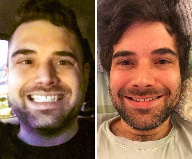 Strabismus korrekció előtt és után.
