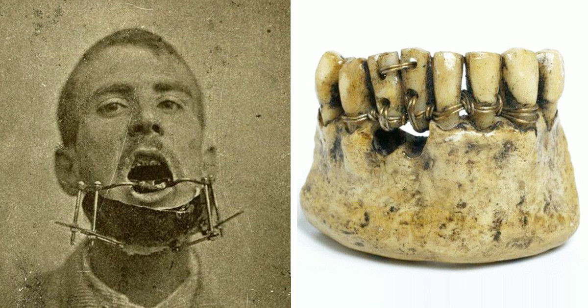 Te sem szeretsz fogorvoshoz járni? Akkor nézd meg, hogyan dolgoztak a múltban