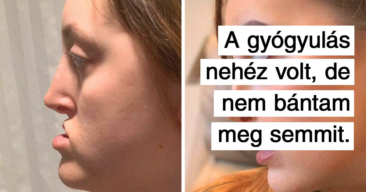 20 ember, aki úgy döntött, hogy plasztikai műtétet csináltat, és csodálatos lett