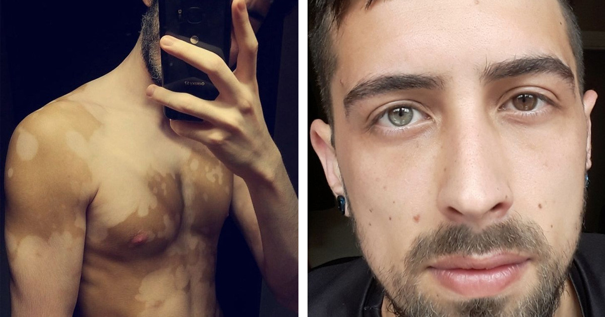 20 ember, akiknek már nem kell kitűnniük a tömegből, mert a természet megtette helyettük