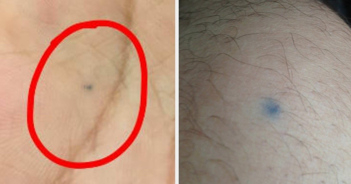 Neked is van ceruzaszúrásból fakadó folt a bőrödön? Ne aggódj, nem vagy egyedül