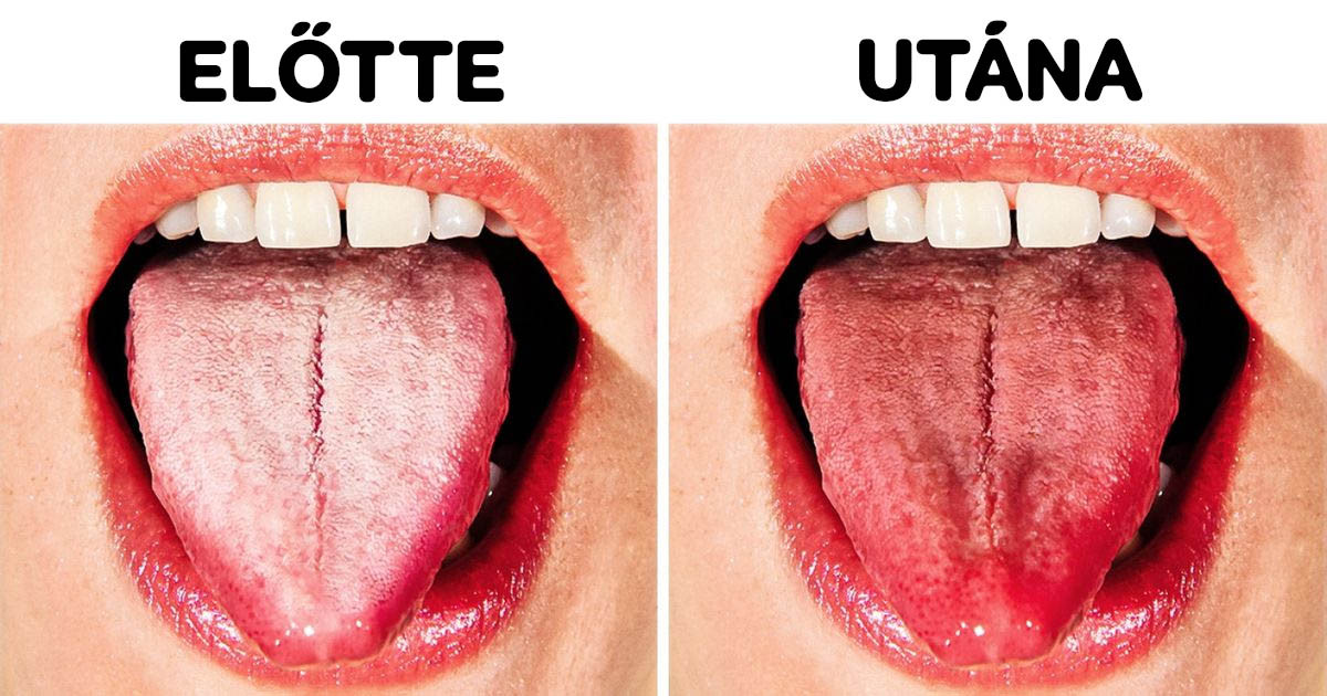 8 módszer, ami segít megszabadulni a fehér nyelvtől és egészségesebbé válni